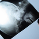 Image for article titled Insurance Types Make a Difference to Survival, For Brain Tumors at Least